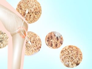Read more about the article 20 października – Światowy Dzień Osteoporozy – Co robić, żeby mieć zdrowe kości?