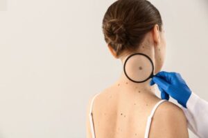 Read more about the article NFZ przypomina o profilaktyce raka skóry i zaprasza na bezpłatne badania dermatoskopem