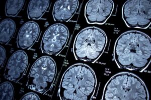Read more about the article Choroby neurologiczne są bliżej niż mogłoby się wydawać. Co druga osoba zna kogoś, kto się z nimi mierzy