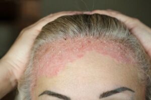 Read more about the article Biologiczne leczenie łuszczycy poprawia jakość życia pacjenta, hamuje rozwój powikłań i chorób współistniejących